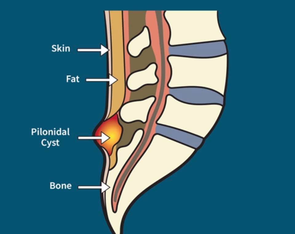 Emergency Surgical Drainage - Pilonidal Treatment Center of New Jersey