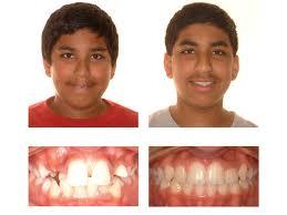 braces