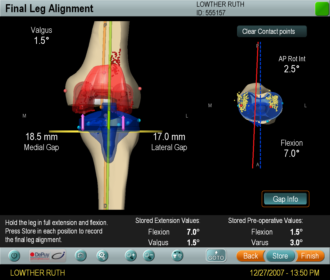 Computer Assisted Surgery