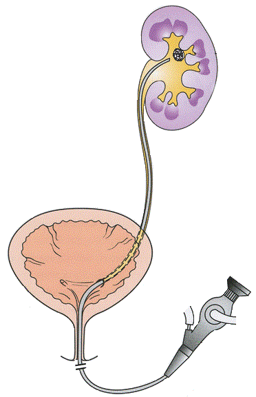 Flexible ureteroscopy