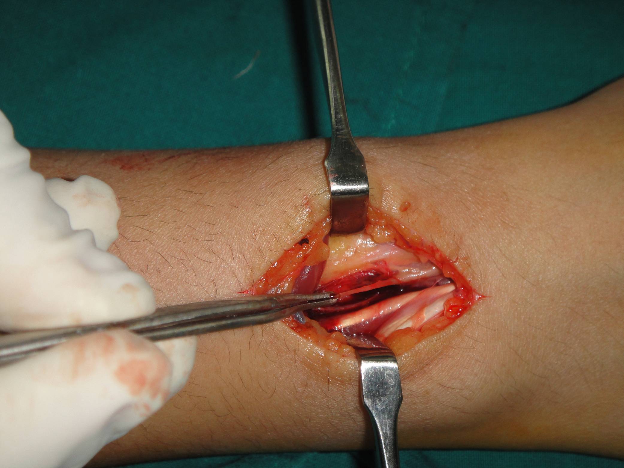 WRIST DENERVATION